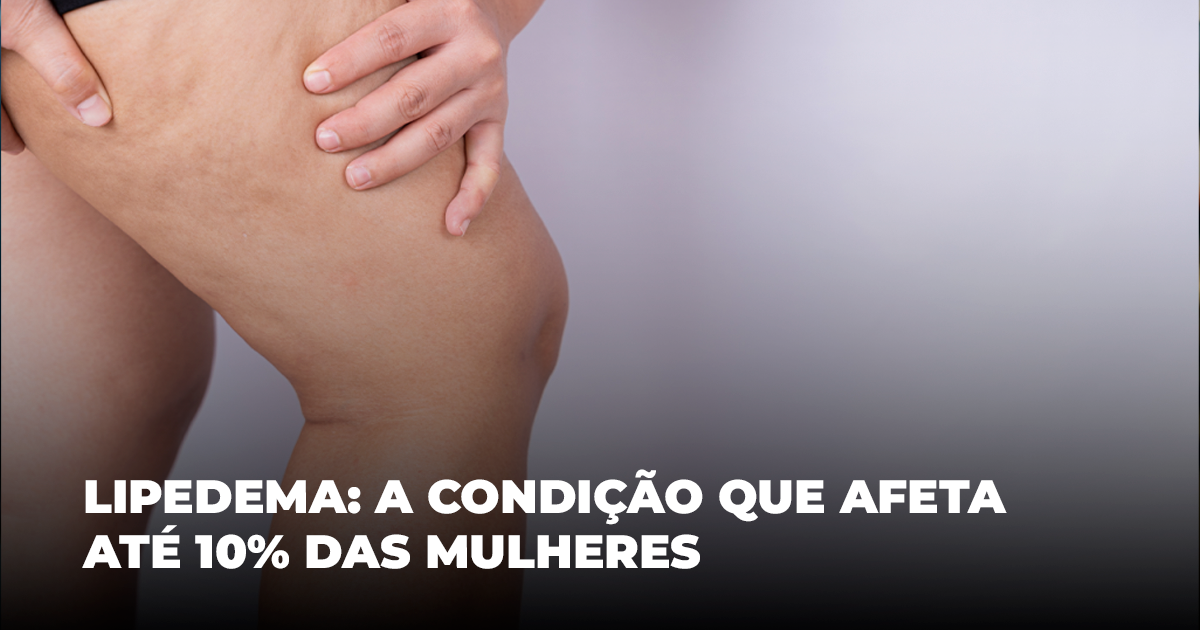 Lipedema: a condição que afeta até 10% das mulheres
